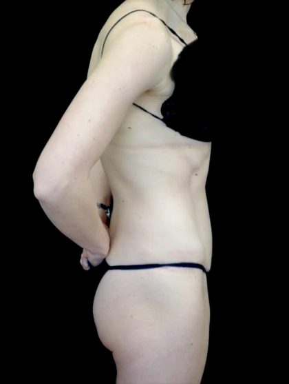 Tummy Tuck Before & After Patient #23425