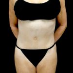 Liposuction Before & After Patient #23369