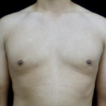 Gynecomastia Before & After Patient #23385