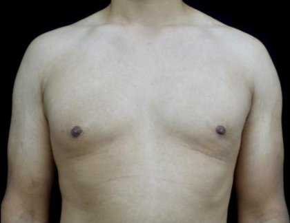 Gynecomastia Before & After Patient #23385