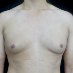 Gynecomastia Before & After Patient #23385