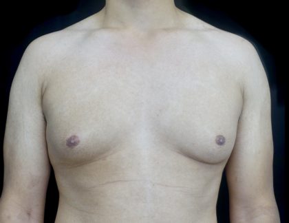 Gynecomastia Before & After Patient #23385