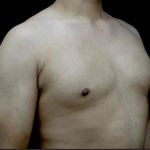 Gynecomastia Before & After Patient #23385