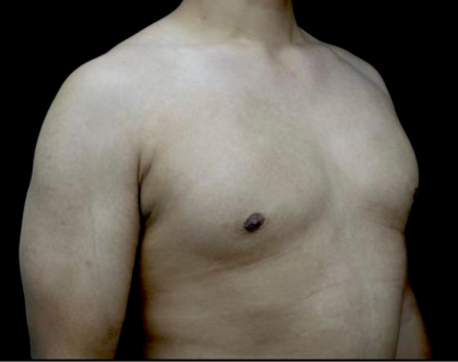 Gynecomastia Before & After Patient #23385