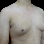 Gynecomastia Before & After Patient #23385