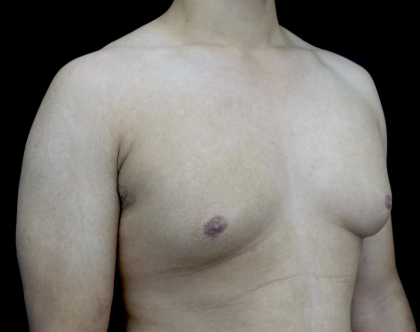 Gynecomastia Before & After Patient #23385