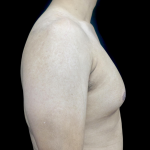 Gynecomastia Before & After Patient #23385