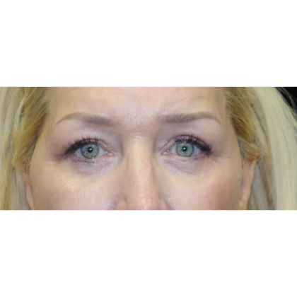 Blepharoplasty Before & After Patient #23420