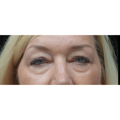 Blepharoplasty Before & After Patient #23420