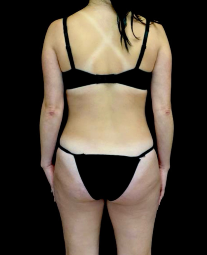 Liposuction Before & After Patient #23411