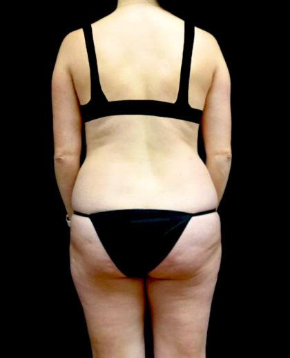 Liposuction Before & After Patient #23411