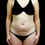 Liposuction Before & After Patient #23411