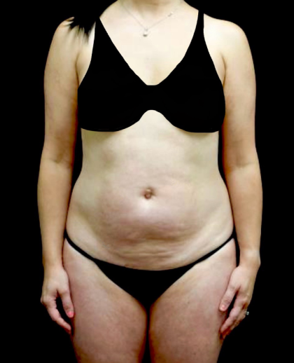 Liposuction Before & After Patient #23411