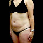 Liposuction Before & After Patient #23411