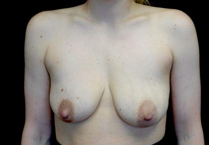 Breast Lift with Implants Before & After Patient #23586