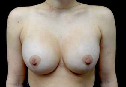 Breast Lift with Implants Before & After Patient #23586