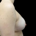 Breast Lift with Implants Before & After Patient #23586