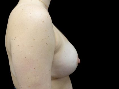 Breast Lift with Implants Before & After Patient #23586