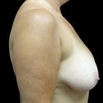 Breast Lift Before & After Patient #23587