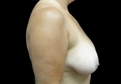 Breast Lift Before & After Patient #23587