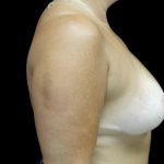 Breast Lift Before & After Patient #23587