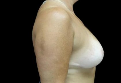 Breast Lift Before & After Patient #23587