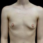 Breast Augmentation (Implants) Before & After Patient #23588