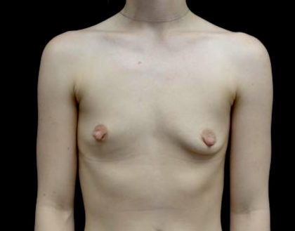 Breast Augmentation (Implants) Before & After Patient #23588