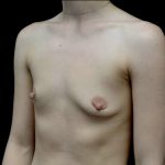 Breast Augmentation (Implants) Before & After Patient #23588