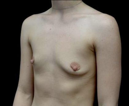 Breast Augmentation (Implants) Before & After Patient #23588