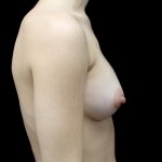 Breast Augmentation (Implants) Before & After Patient #23588