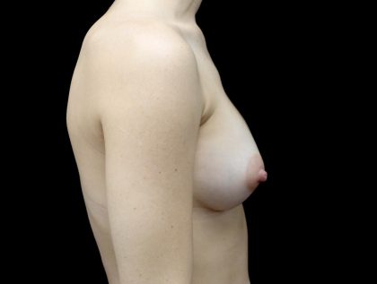 Breast Augmentation (Implants) Before & After Patient #23588