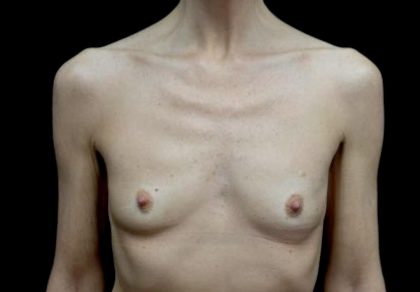 Breast Augmentation (Implants) Before & After Patient #23589