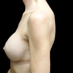 Breast Augmentation (Implants) Before & After Patient #23589