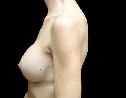 Breast Augmentation (Implants) Before & After Patient #23589