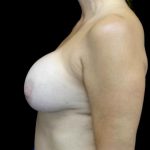 Breast Lift with Implants Before & After Patient #23629