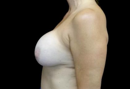 Breast Lift with Implants Before & After Patient #23629