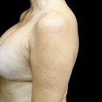 Breast Lift with Implants Before & After Patient #23629