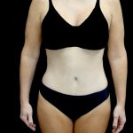 Tummy Tuck Before & After Patient #23675