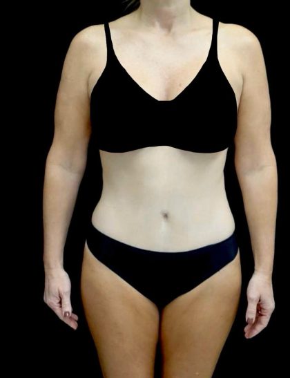 Tummy Tuck Before & After Patient #23675