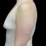 Breast Augmentation (Fat Transfer) Before & After Patient #23662