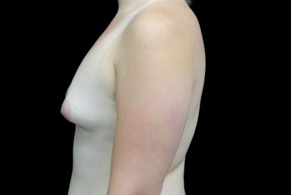 Breast Augmentation (Fat Transfer) Before & After Patient #23662