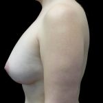 Breast Augmentation (Fat Transfer) Before & After Patient #23662