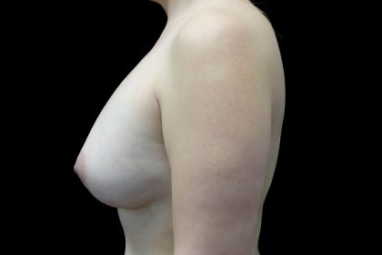 Breast Augmentation (Fat Transfer) Before & After Patient #23662