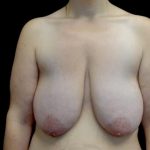 Breast Lift Before & After Patient #23705