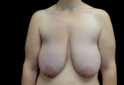 Breast Lift Before & After Patient #23705