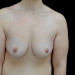 Breast Lift Before & After Patient #23705