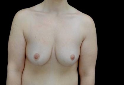 Breast Lift Before & After Patient #23705