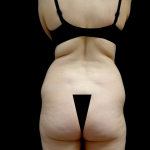 Liposuction Before & After Patient #23696