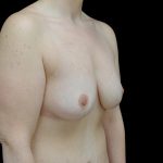 Breast Lift Before & After Patient #23705